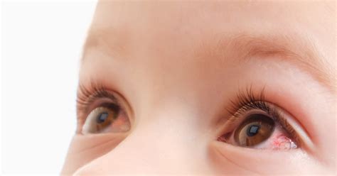 Why Does Your Baby Have Red Eyes? A Parents' Guide