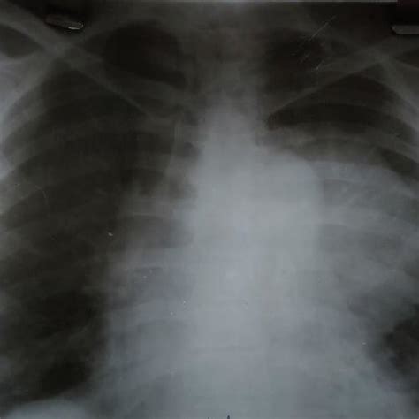 (PDF) A case report on incidental finding of thymoma as anterior mediastinal mass