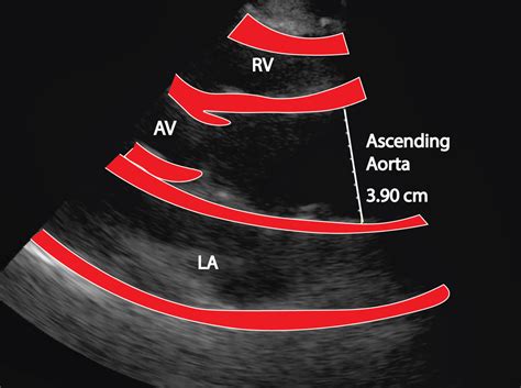 Discovering the aorta through ultrasound - Critical Care Sonography