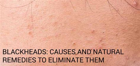 Blackheads: Causes and natural remedies to eliminate them