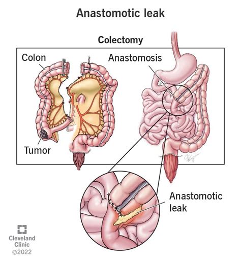 Anastomosis: Definition, Types Procedure, 46% OFF