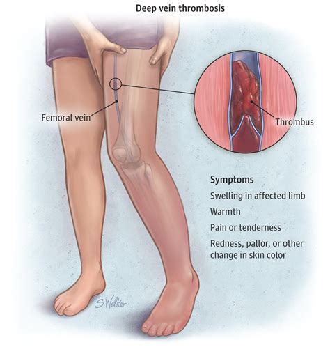 Pain Behind The Knee : Causes, Picture, Symptoms And Treatment