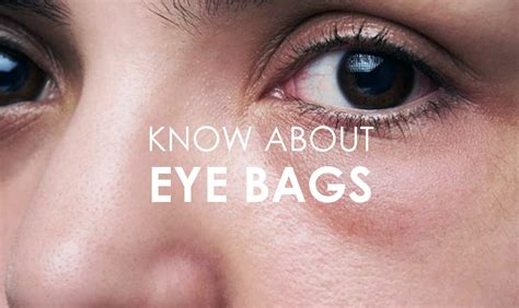 Eye Bags: Types, Causes & Treatment - Premier Clinic