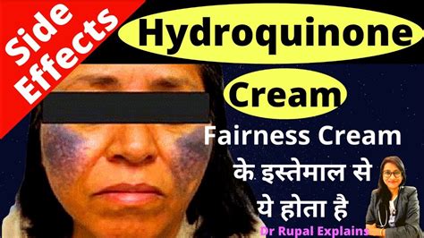 HYDROQUINONE CREAM SIDE EFFECTS - Melacare Forte Cream Over Dose से नुक़सान ? Dr Rupal Explains ...