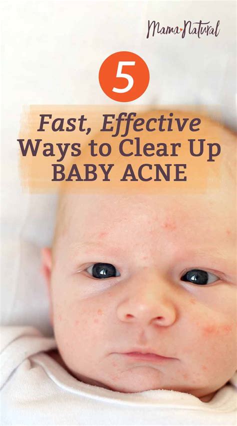 Baby Acne: What Causes It & How to Treat Naturally - Mama Natural