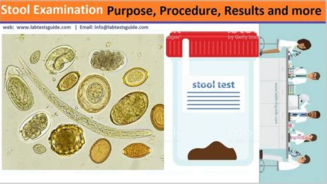 Stool Examination Purpose, Procedure, Results And More | Lab Tests Guide