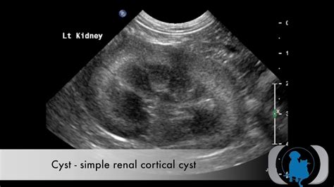 Renal Cortical Cyst Ultrasound