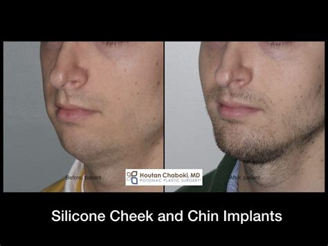 Silicone Cheek Implant Surgery