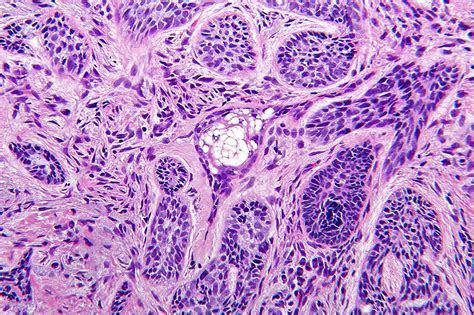 Morpheaform Basal Cell Carcinoma Histology