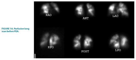 Perfusion lung scan after pulmonary artery endarterectomy in patients ...