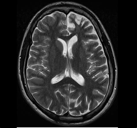 RASMUSSEN SYNDROME