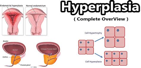 Hyperplasia definition, congenital adrenal, endometrial & prostatic hyperplasia