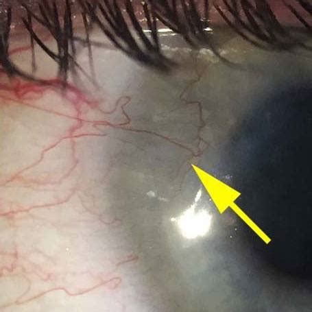 Salzmann Nodular Degeneration of the cornea - The ELZA Institute