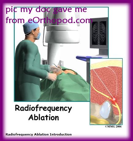 Si Joint Nerve Ablation Procedure - mapasgmaes