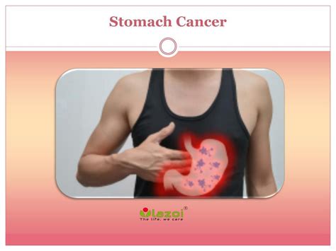 PPT - Stomach Cancer: Causes, Symptoms, Daignosis, Prevention and ...