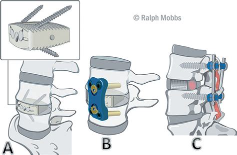 Types Of Lumbar Spinal Fusion Surgery - Design Talk