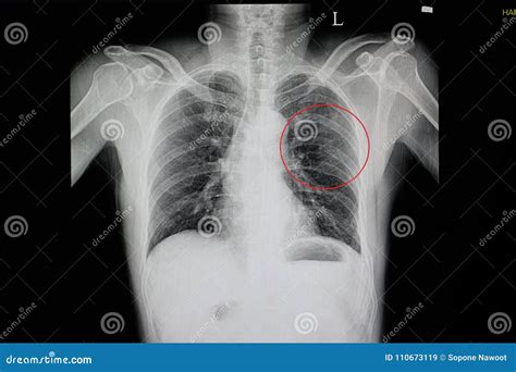 Chest X-ray of a Blunt Chest Wall Injuried Patient Stock Image - Image of care, left: 110673119