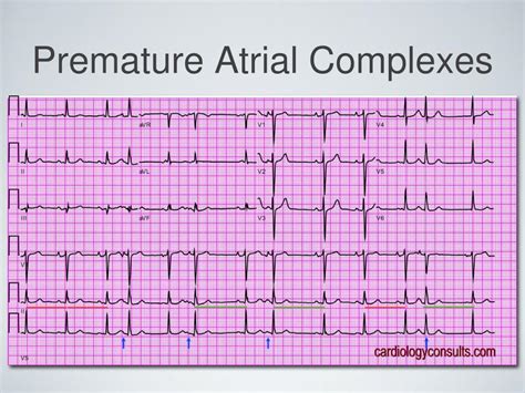 PPT - Recognizing Cardiac arrhythmias PowerPoint Presentation, free download - ID:4613819