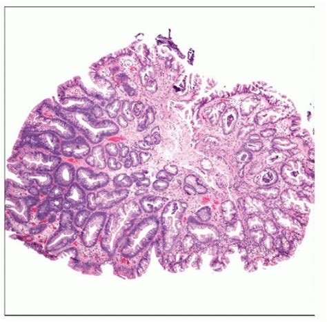 Tubular Adenoma Polyp Histology