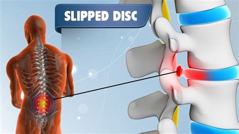 Slipped Disc Symptoms, Causes And Treatment Disc Prolapse, 52% OFF