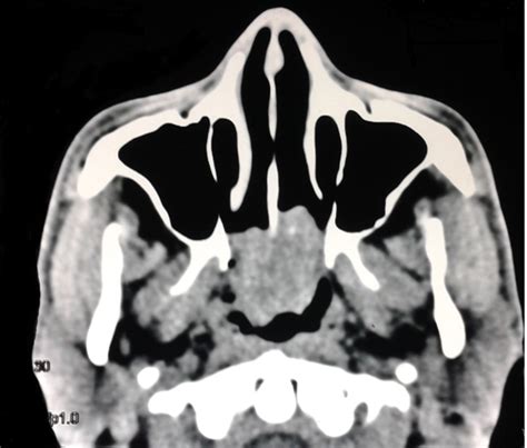 Nasal Polyp Ct Scan