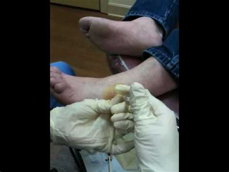 Injection of subtalar joint - YouTube