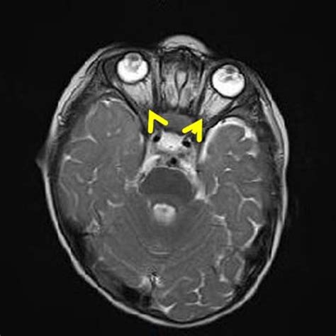 T2-weighted MRI brain scan of twin II, showing bilateral microphthalmia ...