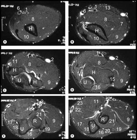 Sagittal Mri Elbow Anatomy