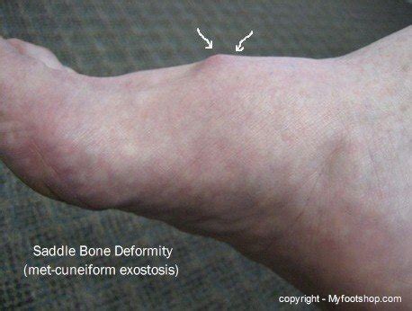 Saddle Bone Deformity | Causes and treatment options | MyFootShop.com