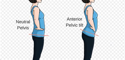 The anterior pelvic tilt. – Beathardflaccid