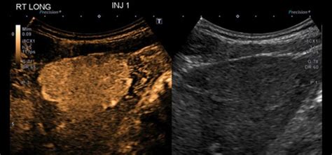 Imaging with Microbubbles: Contrast Enhanced Ultrasound - Radiating Hope