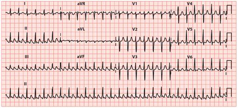 Atrial Flutter: ECG Interpretation [With Examples] - Manual of Medicine