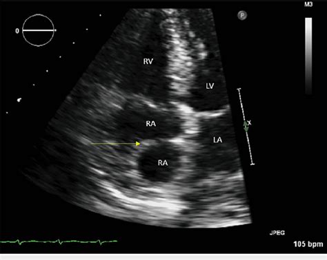 Transthoracic echocardiogram (TTE) ECHO showing a mass in the right ...