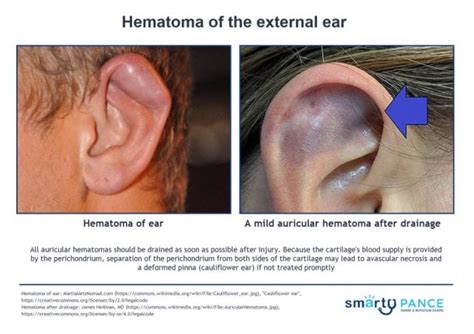 Hematoma of the external ear - Smarty PANCE