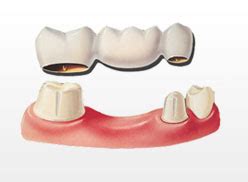 Porcelain Bridges in Irvine ca | Sand Canyon Dental