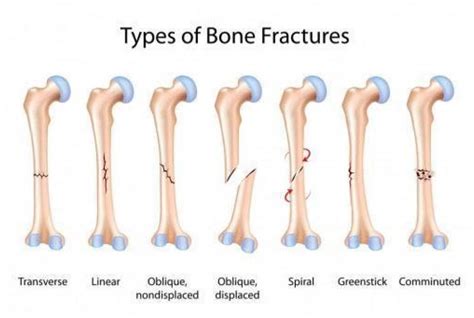 Types Of Long Bone Fractures