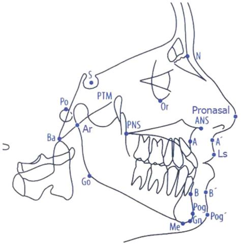 Cephalometric Landmarks Bolton