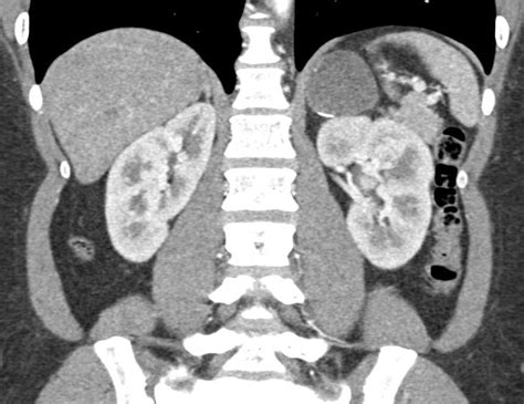 Left Adrenal Adenoma - Adrenal Case Studies - CTisus CT Scanning