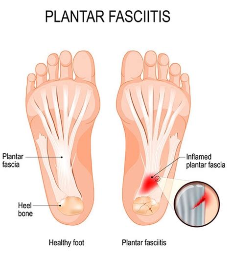 7 Common Foot Problems for Runners