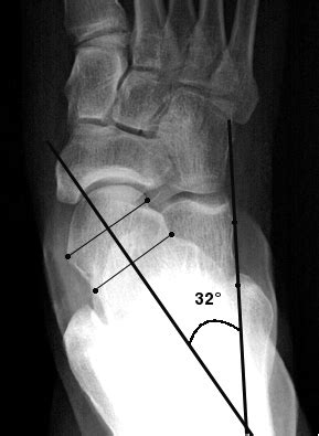 pes_planus [Foot Alignment]