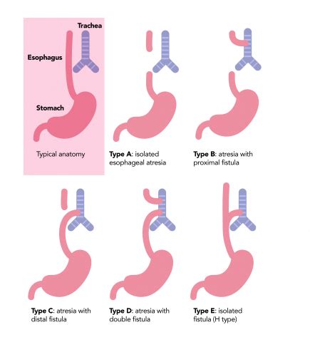 Esophageal Atresia Types