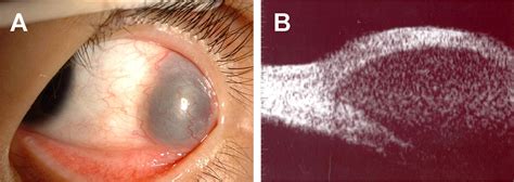 A conjunctival cyst with delayed internal hemorrhage after strabismus ...