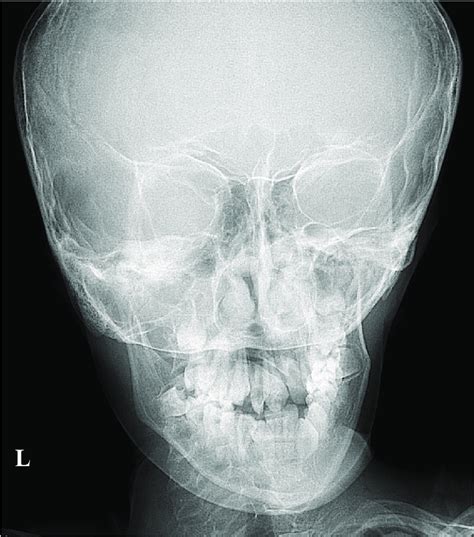 Lateral cephalogram showing steep mandibular plane. | Download High-Resolution Scientific Diagram