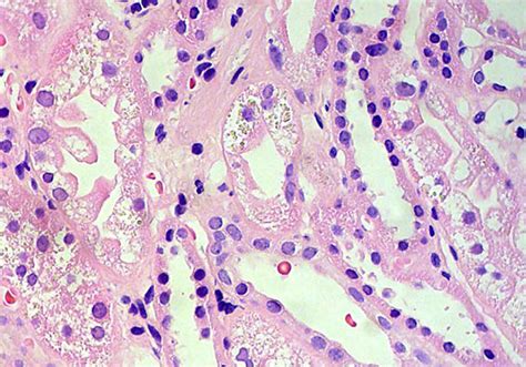 Proteinuria - Glucosuria