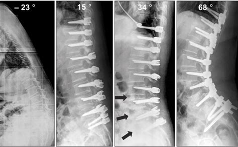 A 68-year-old female patient with degenerative flat back syndrome.... | Download Scientific Diagram