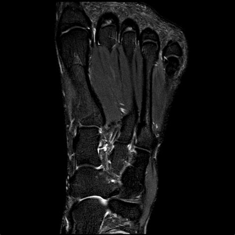 Foot Mri Anatomy - Anatomy Reading Source