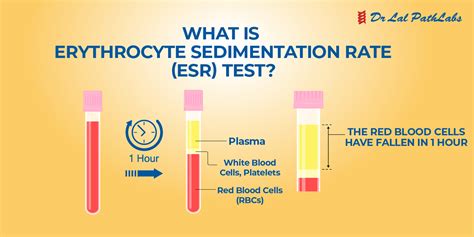 Erythrocyte Sedimentation Rate (ESR) Test: What You Need To Know - Dr Lal PathLabs Blog