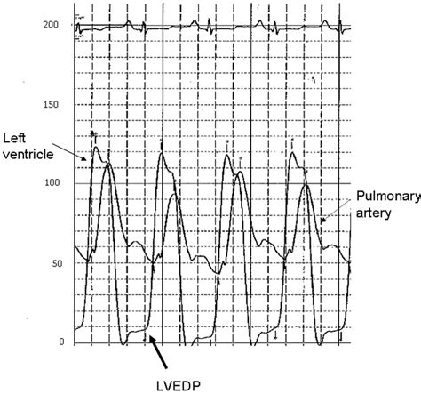 Concomitant left ventricle pressure and pulmonary artery pressure ...