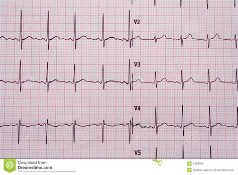 результаты ekg стоковое изображение. изображение насчитывающей притяжка ...