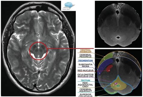 一文掌握中脑解剖结构及常见综合征|图文并茂__医脉通